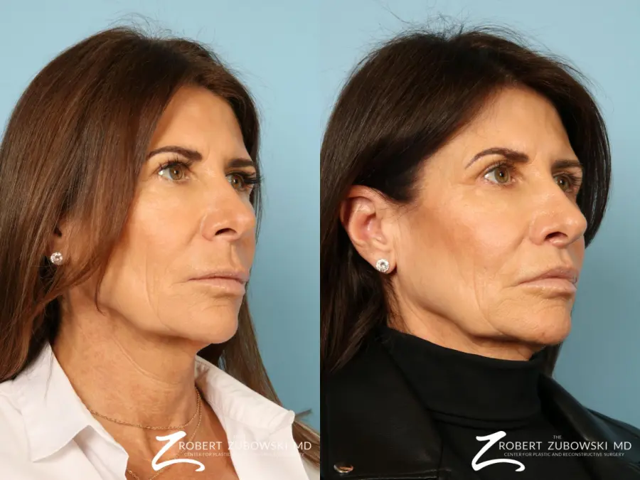 Lip Augmentation: Patient 1 - Before and After 3