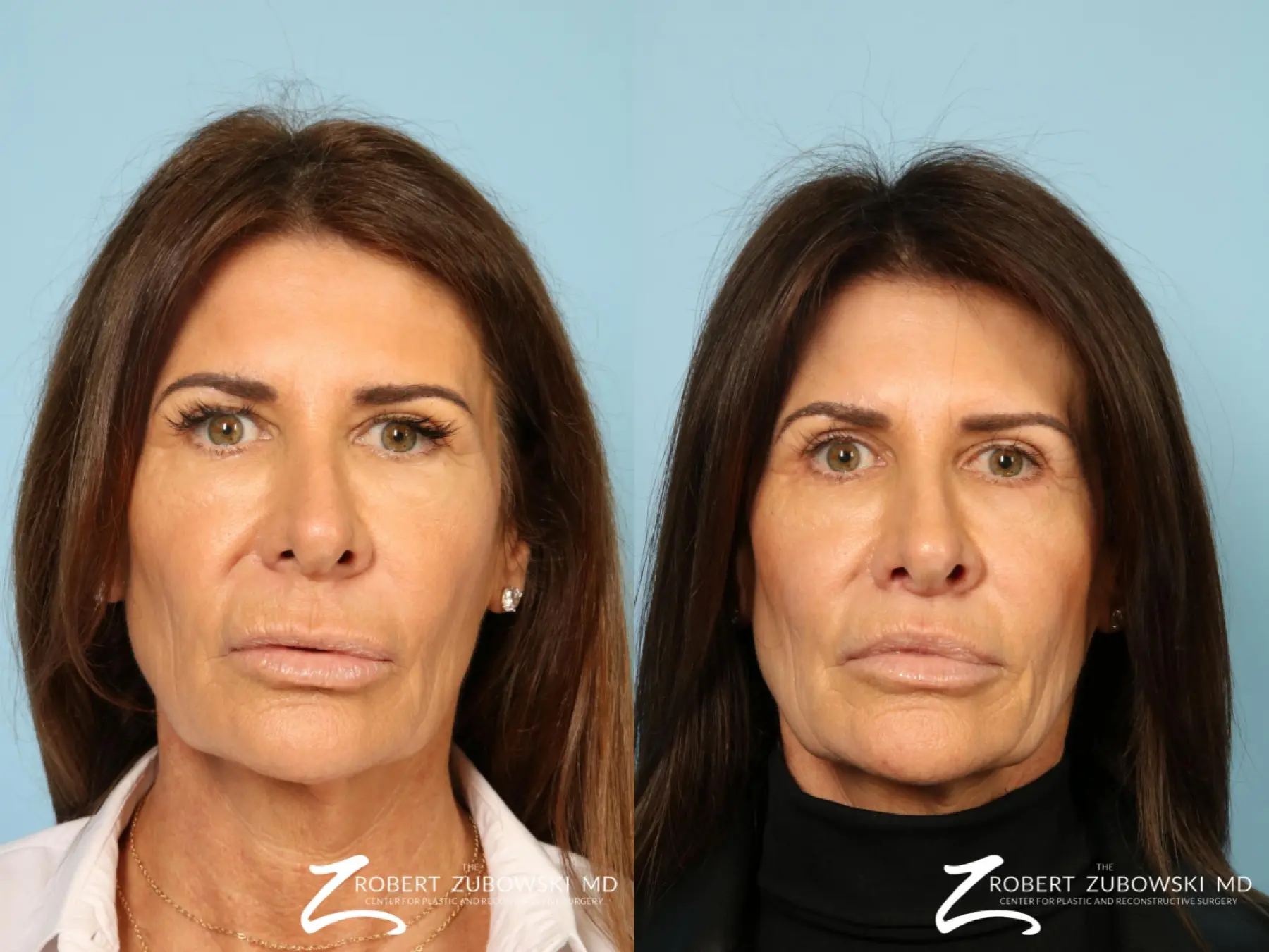 Lip Augmentation: Patient 1 - Before and After  