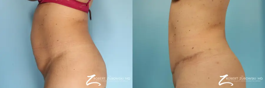 Lipoabdominoplasty: Patient 1 - Before and After 2