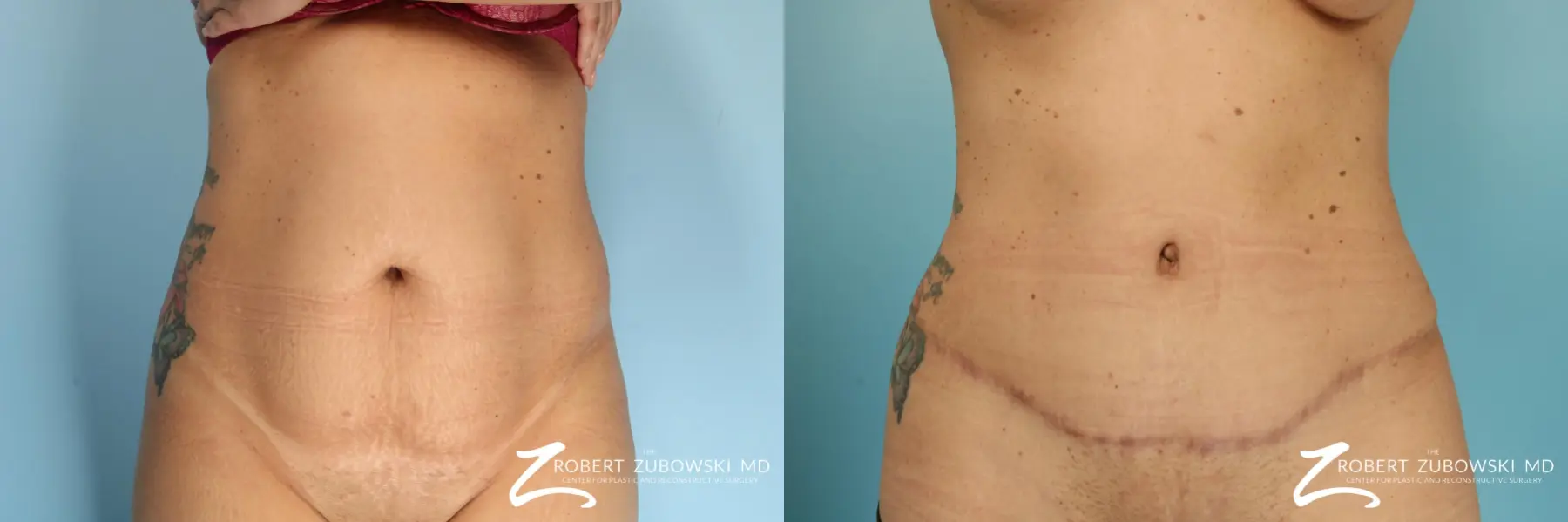 Lipoabdominoplasty: Patient 1 - Before and After  