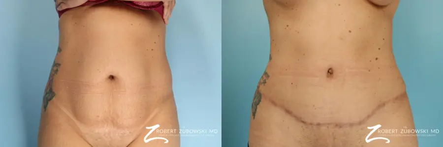 Lipoabdominoplasty: Patient 1 - Before and After 1