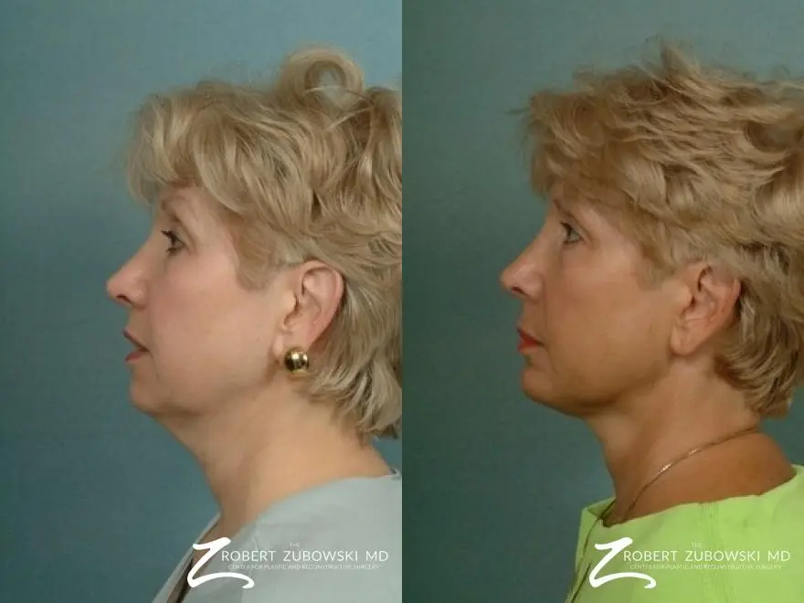 Liposuction: Patient 44 - Before and After 2