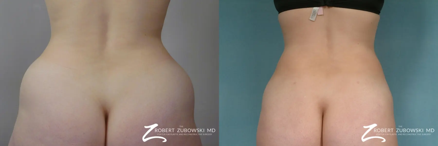 Liposuction: Patient 48 - Before and After 6