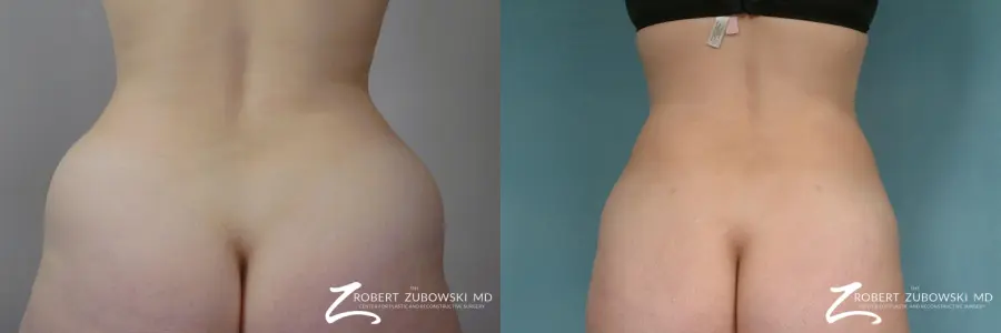 Liposuction: Patient 48 - Before and After 6