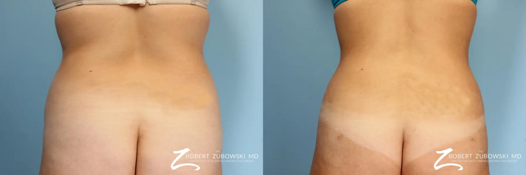 Liposuction: Patient 8 - Before and After  