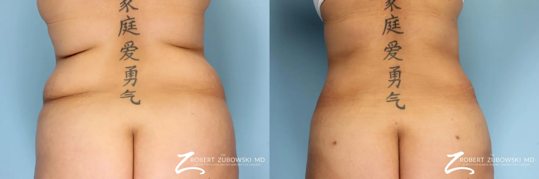 Liposuction: Patient 10 - Before and After  