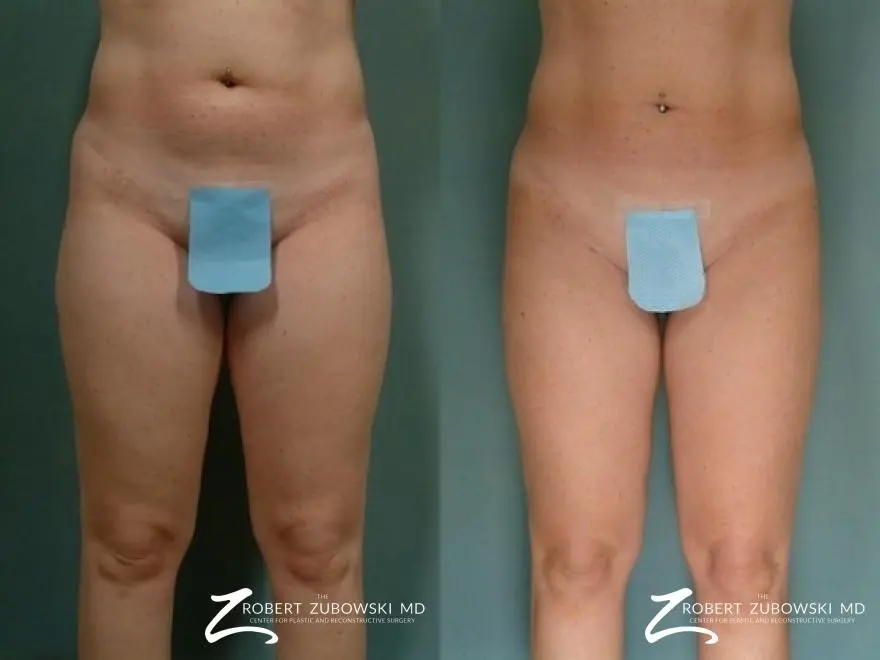 Liposuction: Patient 41 - Before and After 1