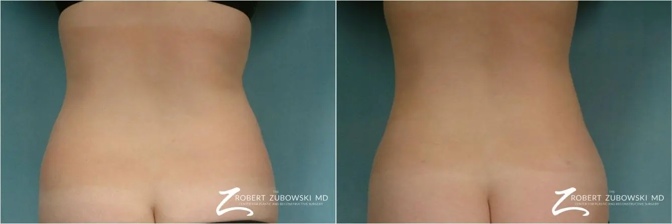 Liposuction: Patient 24 - Before and After  