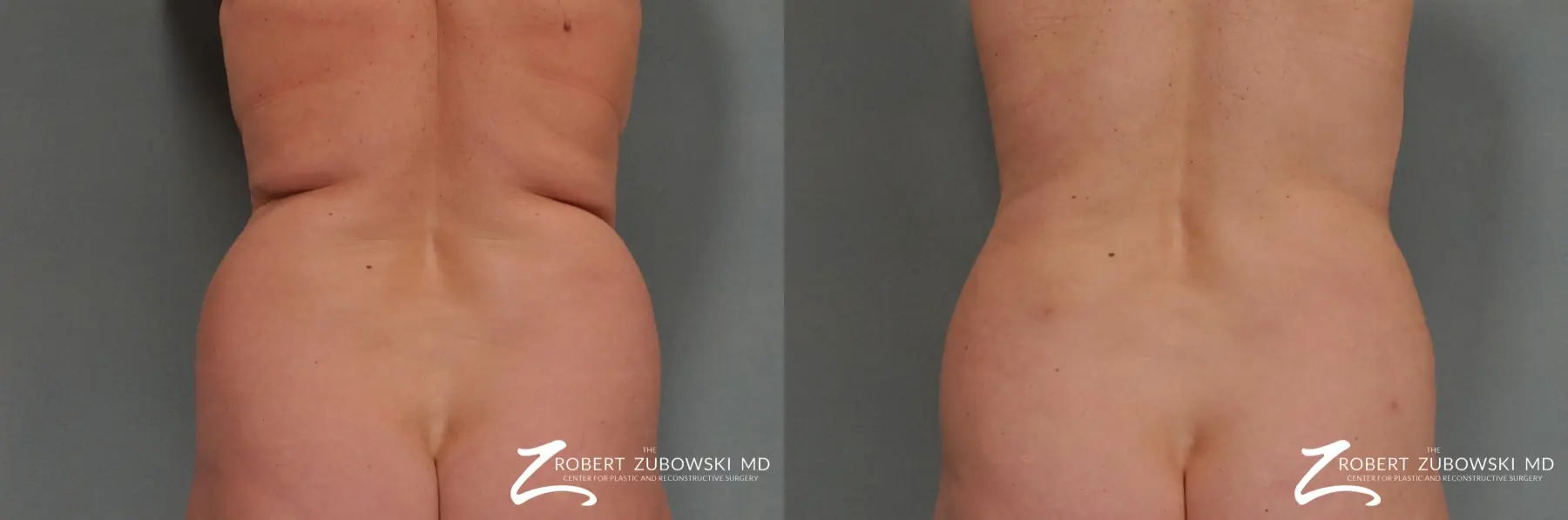 Liposuction: Patient 14 - Before and After  