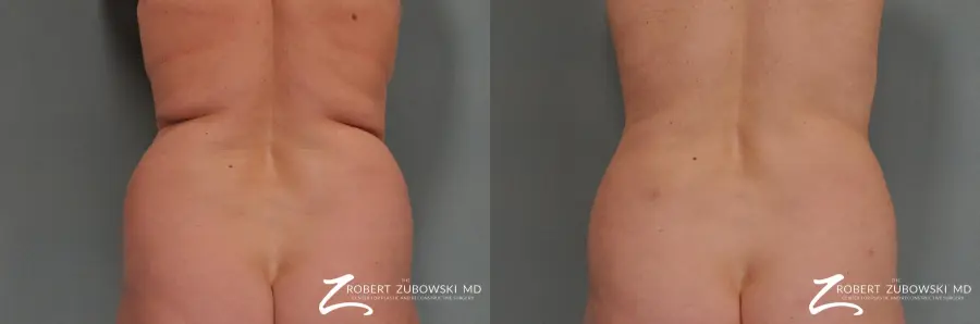 Liposuction: Patient 22 - Before and After  