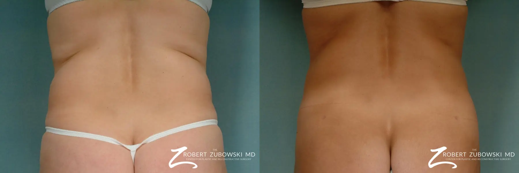 Liposuction: Patient 22 - Before and After 3