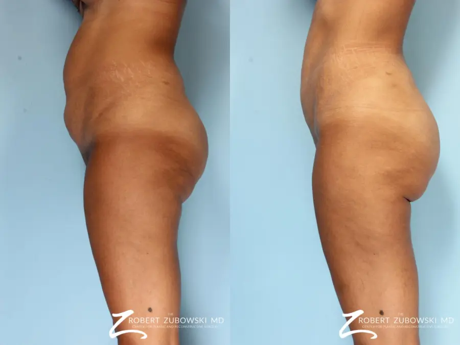 Liposuction: Patient 43 - Before and After 3