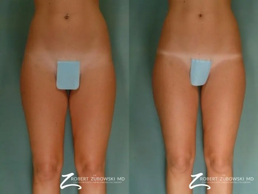 Liposuction: Patient 47 - Before and After  
