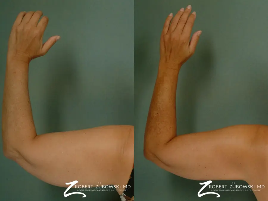 Liposuction: Patient 23 - Before and After  