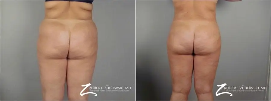 Liposuction: Patient 32 - Before and After 3