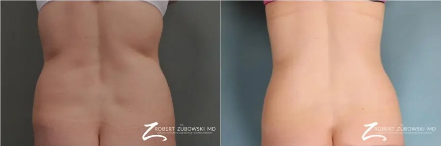 Liposuction: Patient 25 - Before and After 1