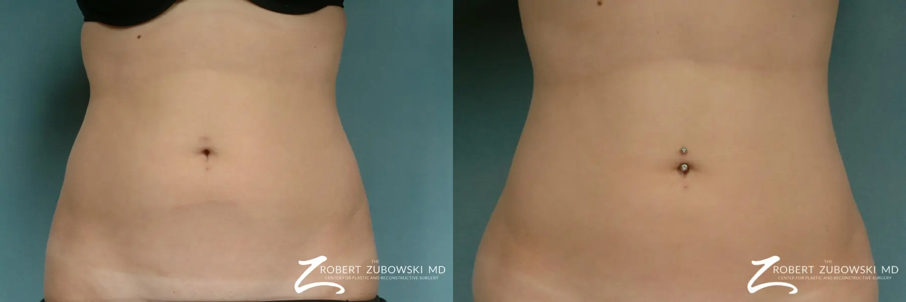 Liposuction: Patient 20 - Before and After  