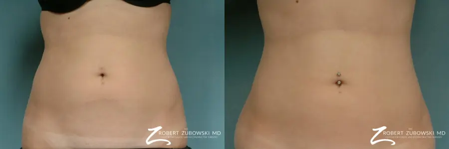 Liposuction: Patient 31 - Before and After  