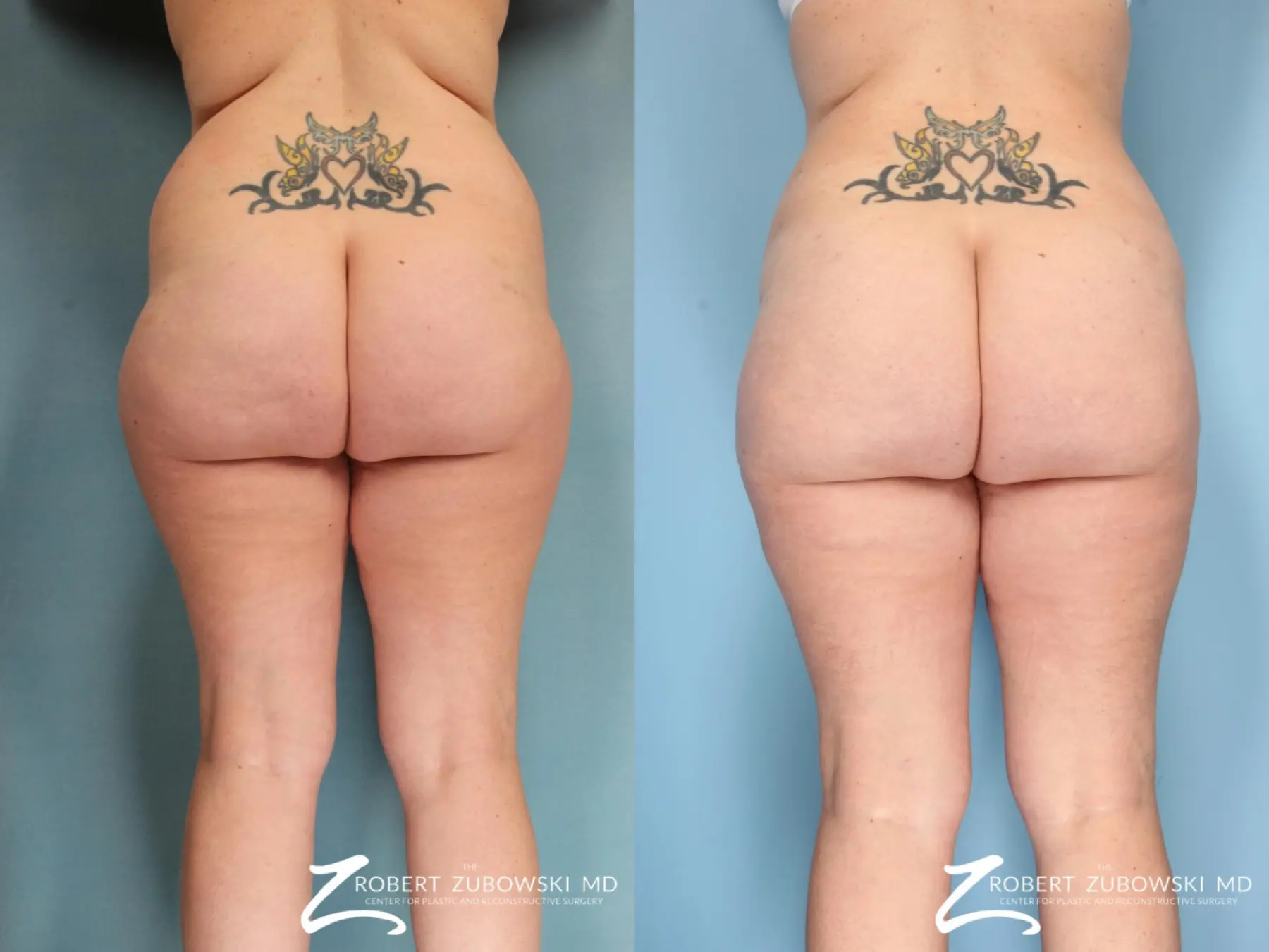 Liposuction: Patient 49 - Before and After 1