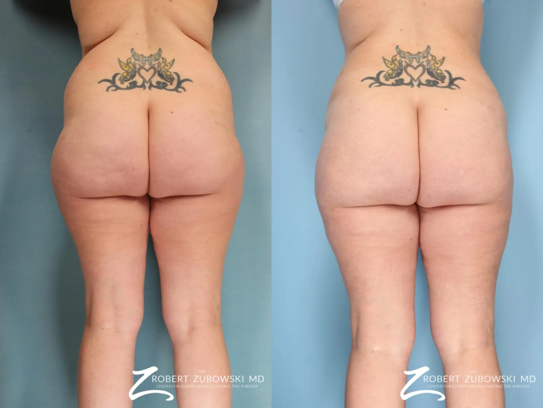 Liposuction: Patient 49 - Before and After  