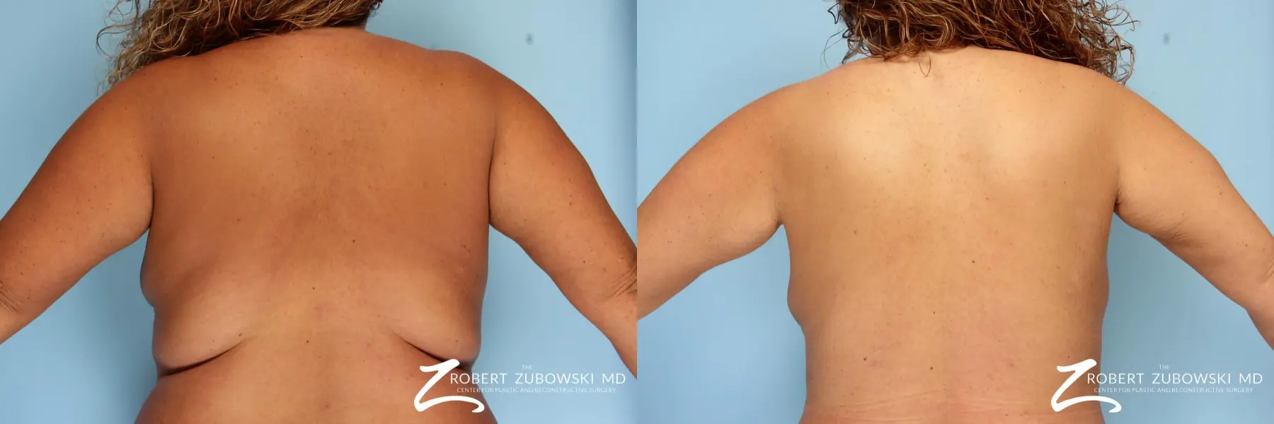 Liposuction: Patient 4 - Before and After 1