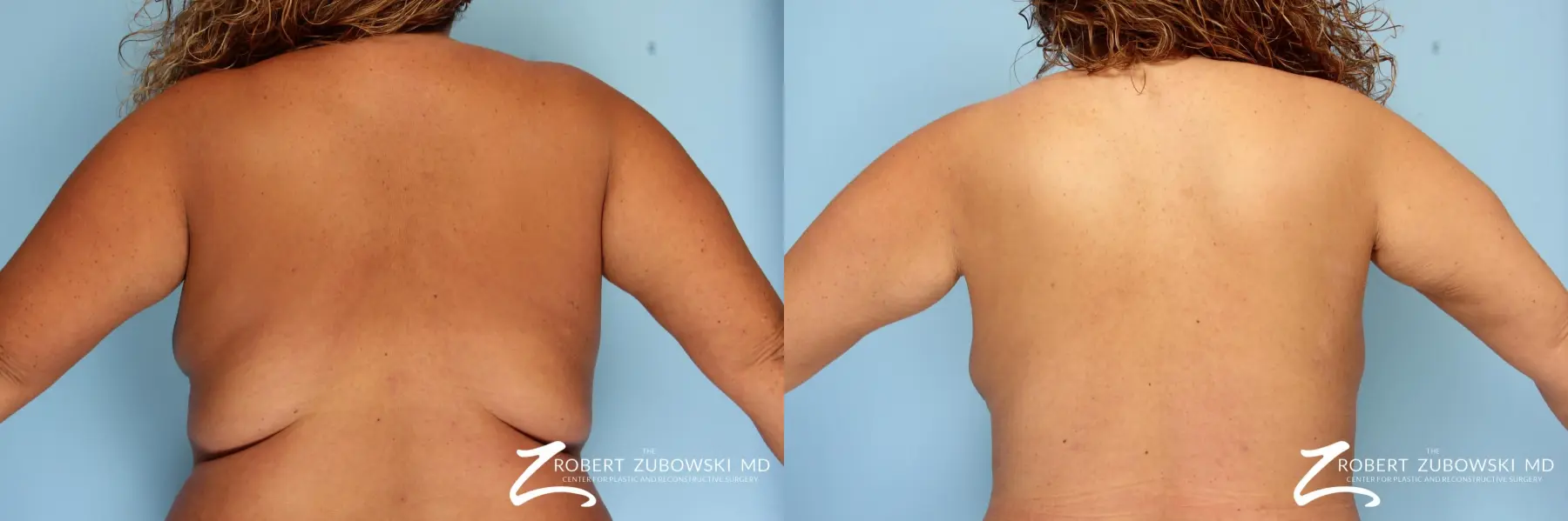 Liposuction: Patient 4 - Before and After  