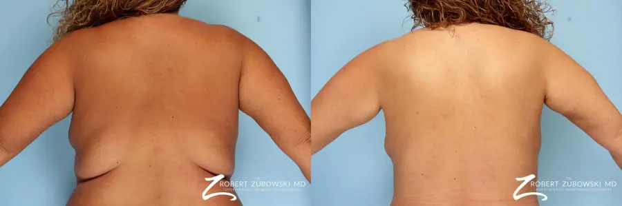 Liposuction: Patient 9 - Before and After  