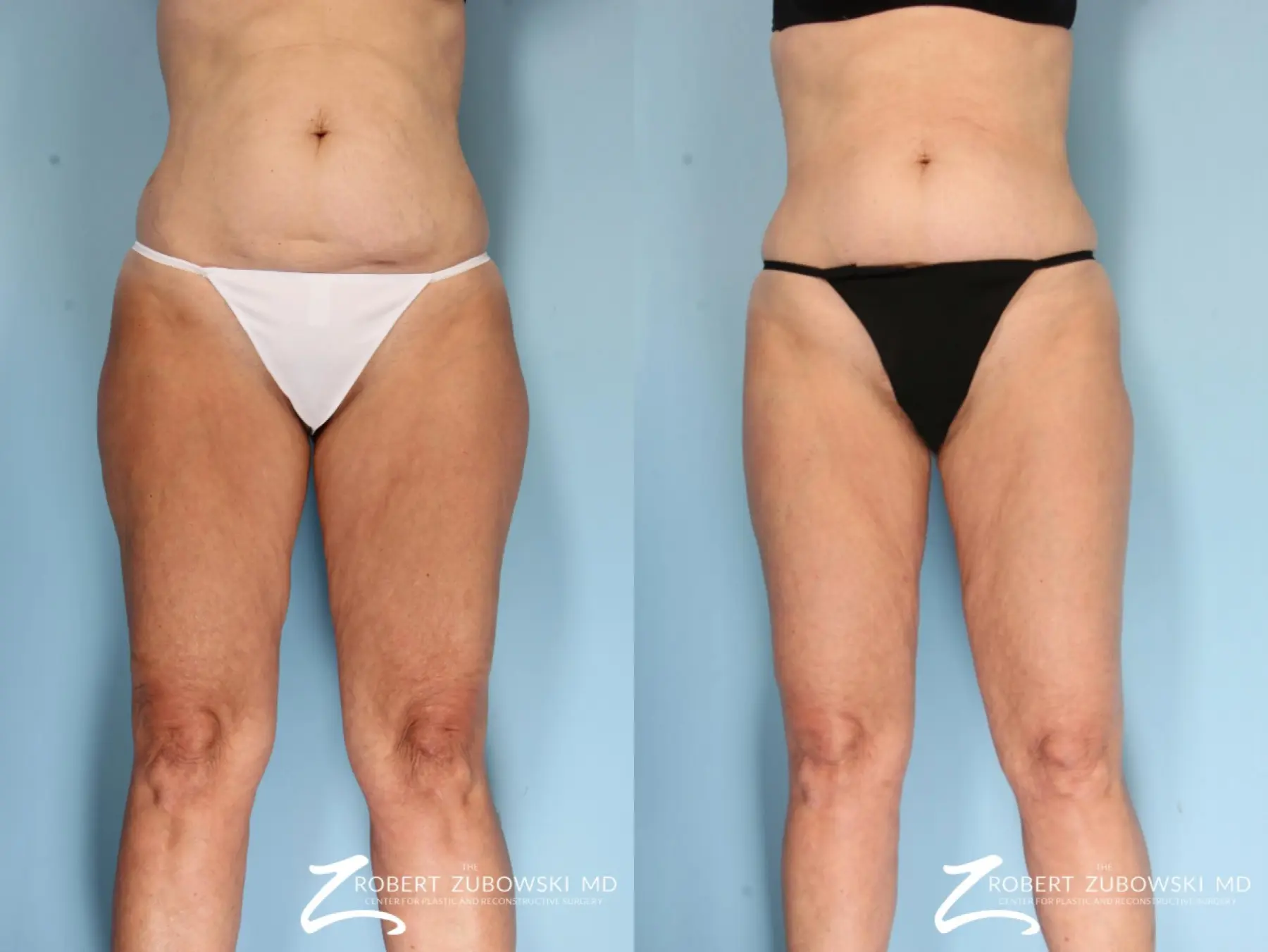 Liposuction: Patient 36 - Before and After 1