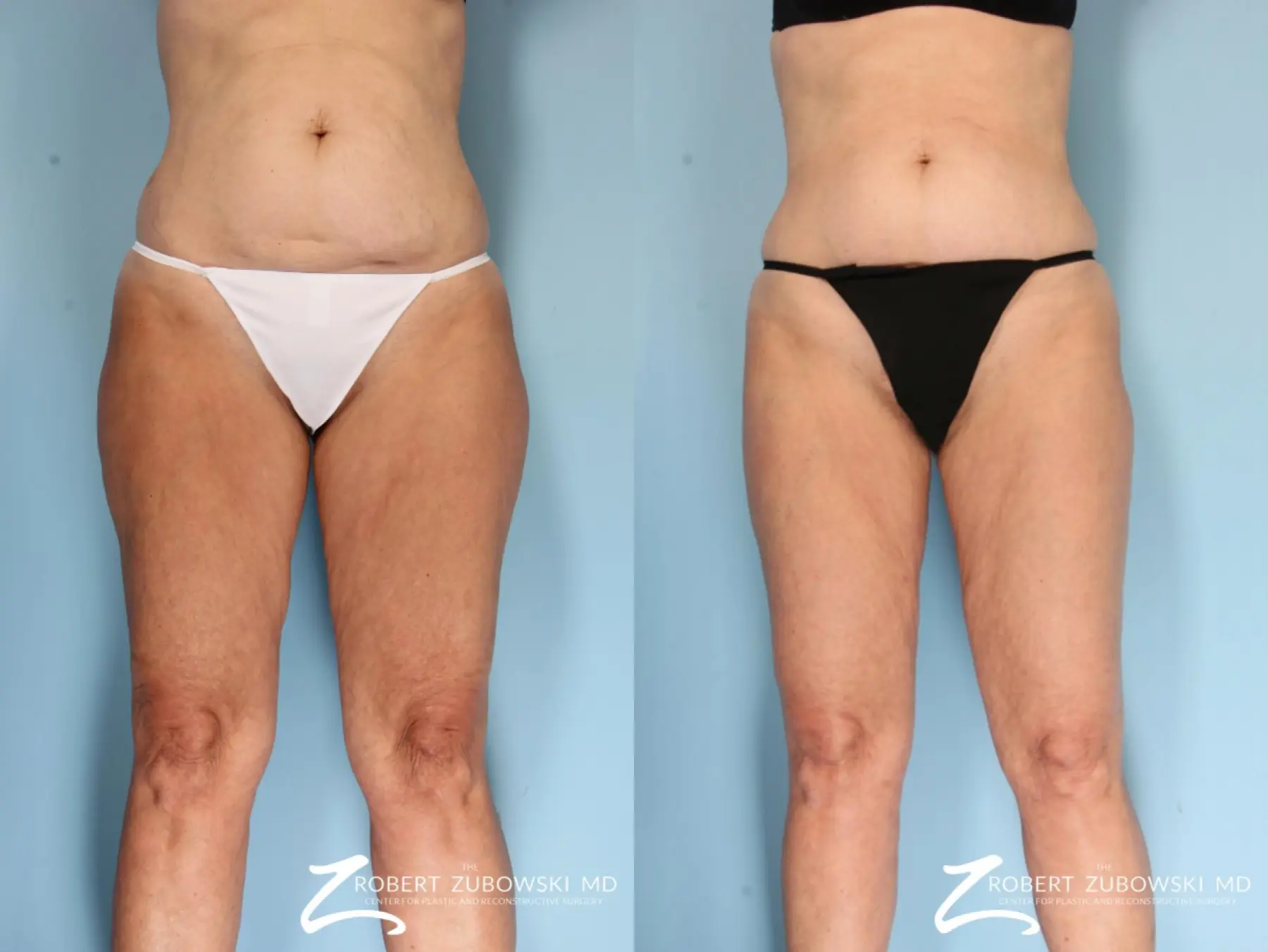 Before and After Liposuction Gallery