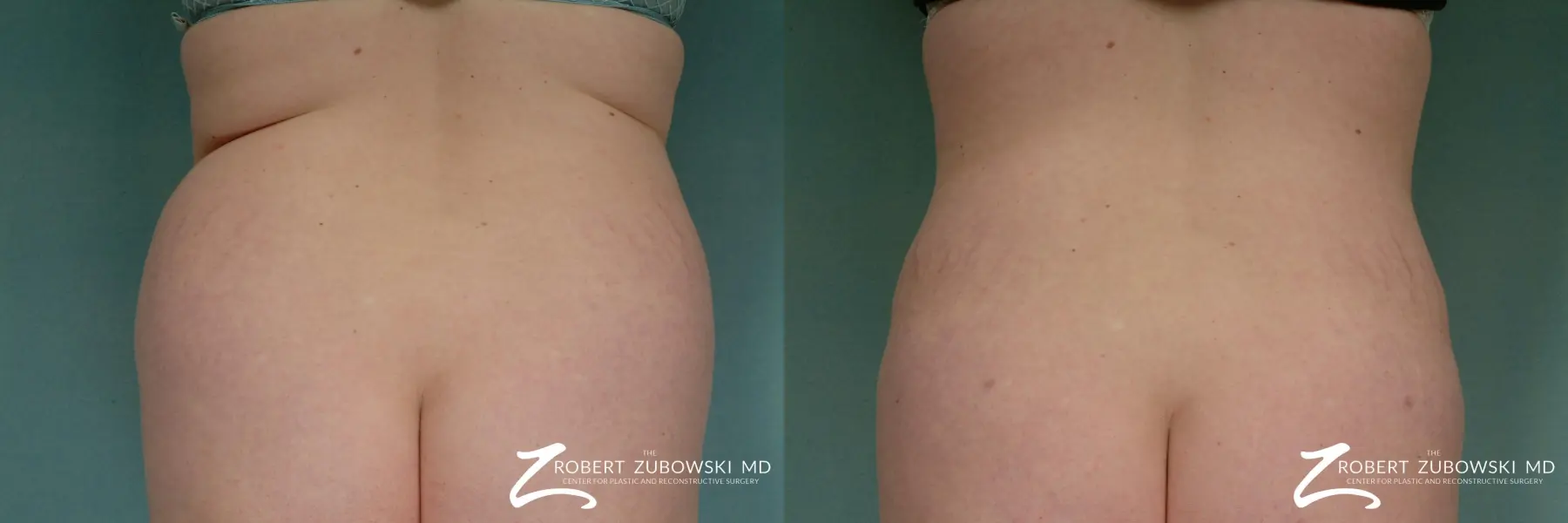 Liposuction: Patient 18 - Before and After  