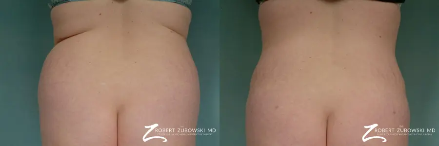 Liposuction: Patient 28 - Before and After  