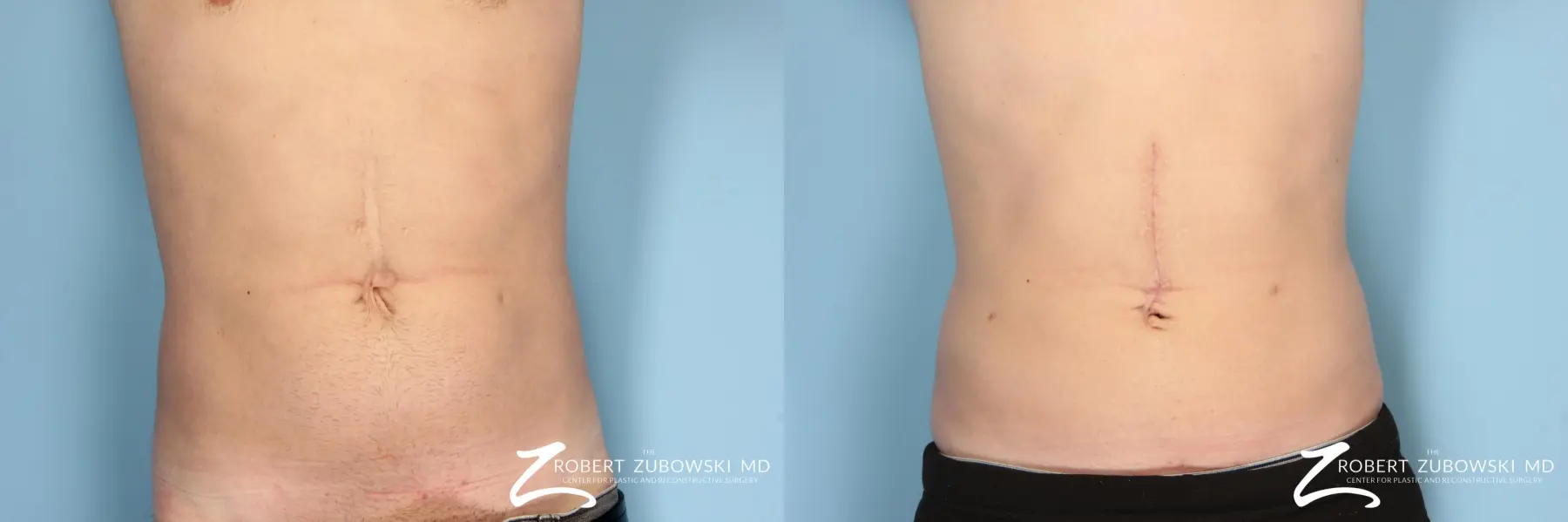 Liposuction: Patient 11 - Before and After  