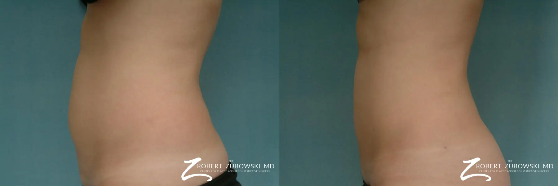 Liposuction: Patient 20 - Before and After 3