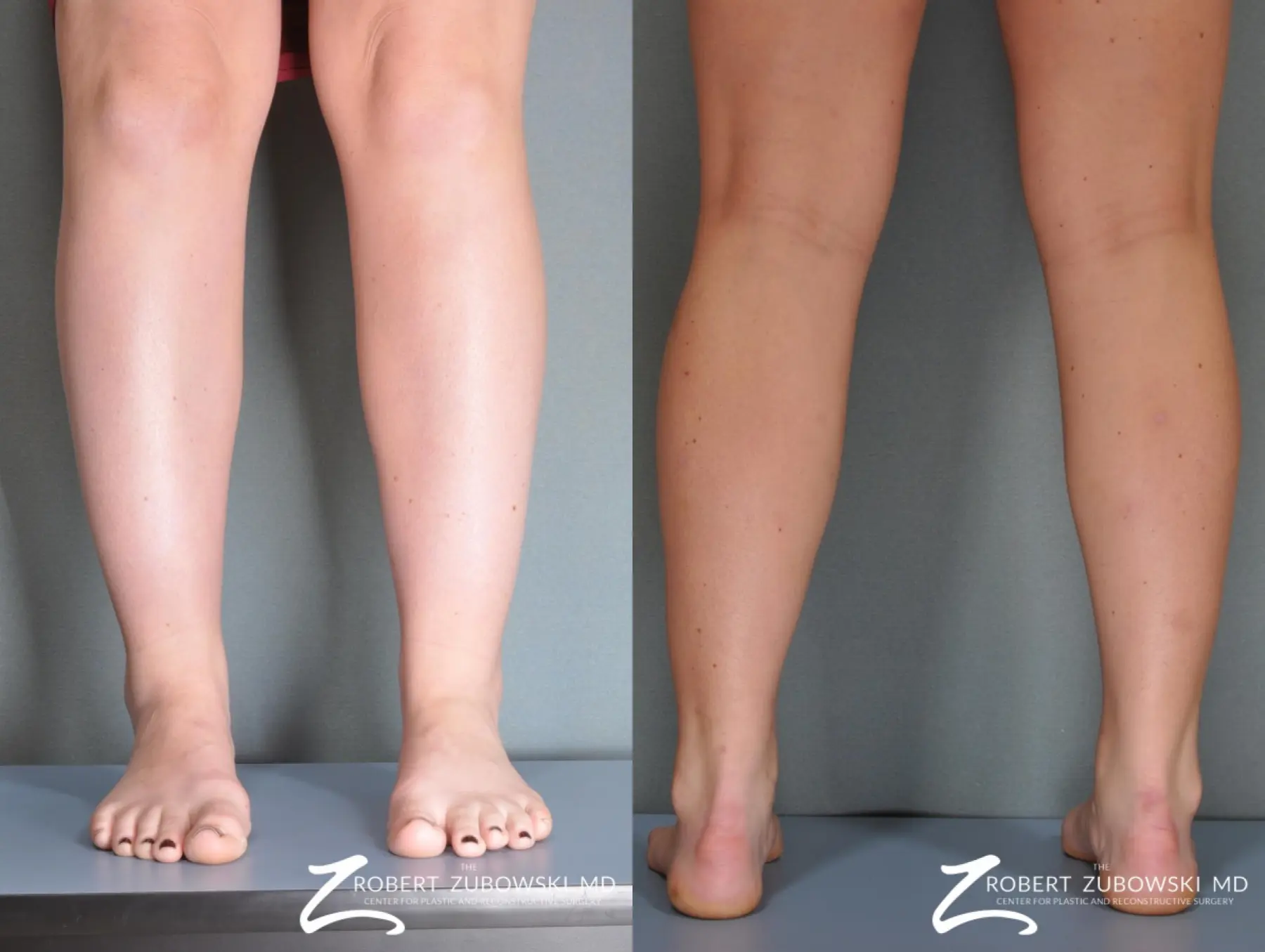 Liposuction: Patient 37 - Before and After  