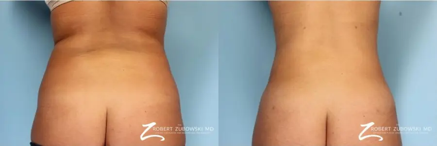 Liposuction: Patient 37 - Before and After  