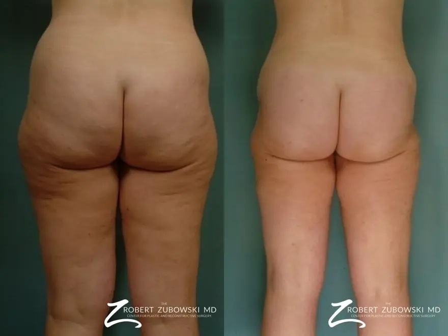 Liposuction: Patient 46 - Before and After 2