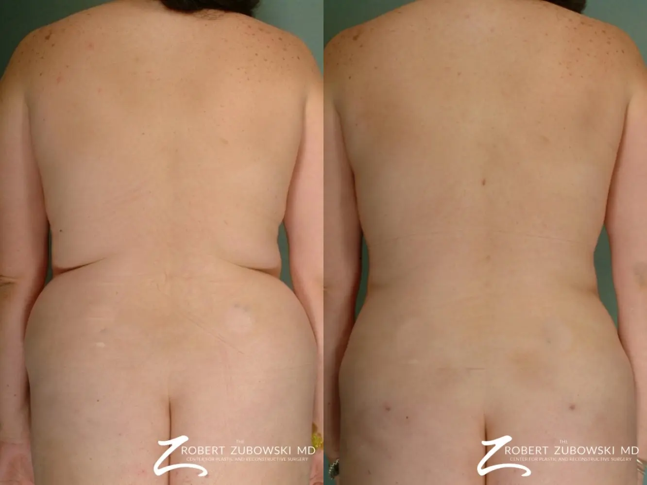 Liposuction: Patient 35 - Before and After  