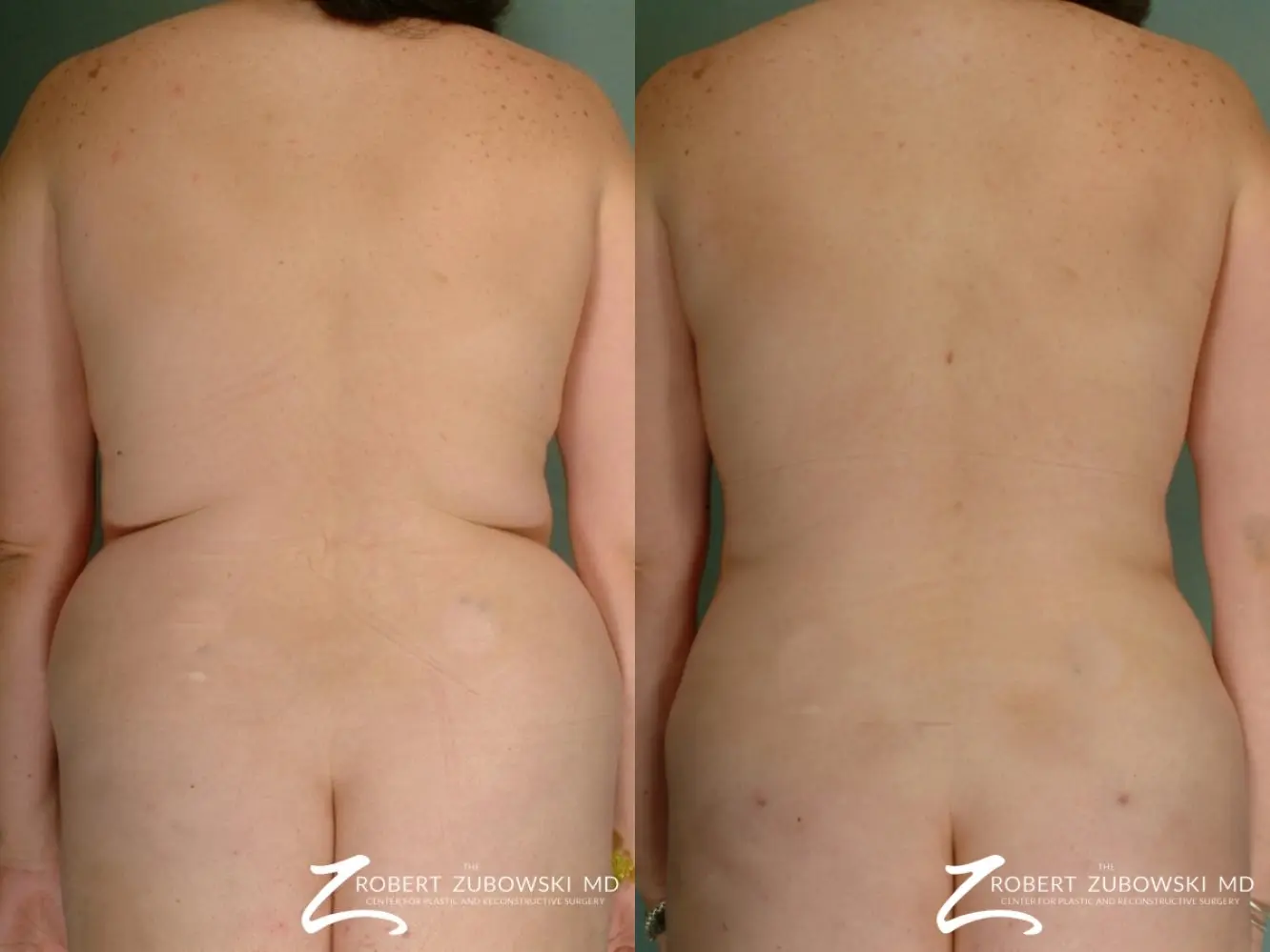 Liposuction Back and Flanks Treatment Gallery in New Bern, NC