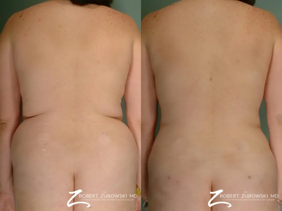 Liposuction: Patient 25 - Before and After  