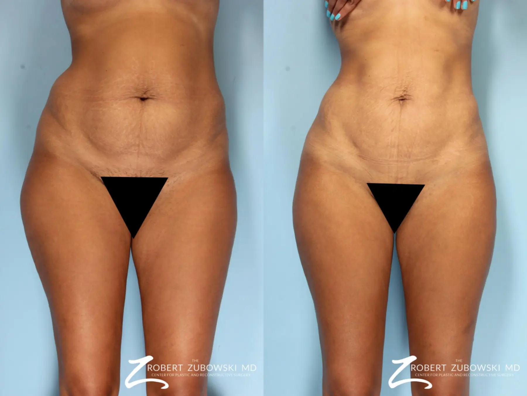 Liposuction: Patient 43 - Before and After  