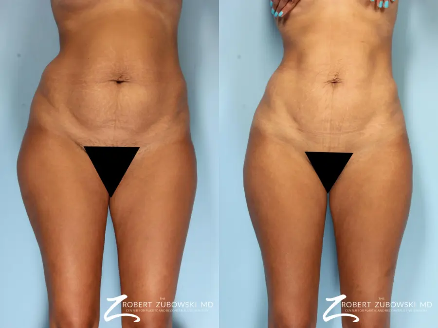 Liposuction: Patient 49 - Before and After  