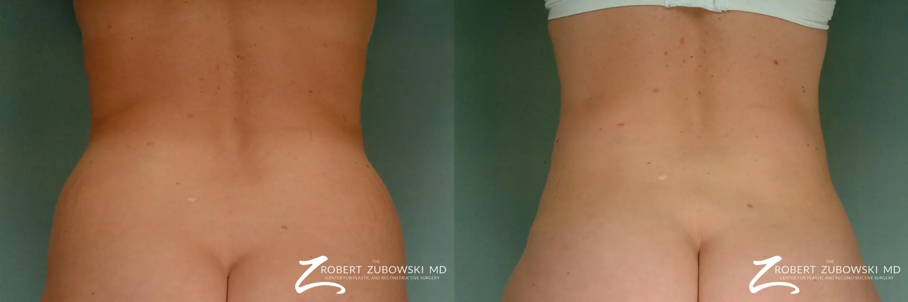 Liposuction: Patient 23 - Before and After  