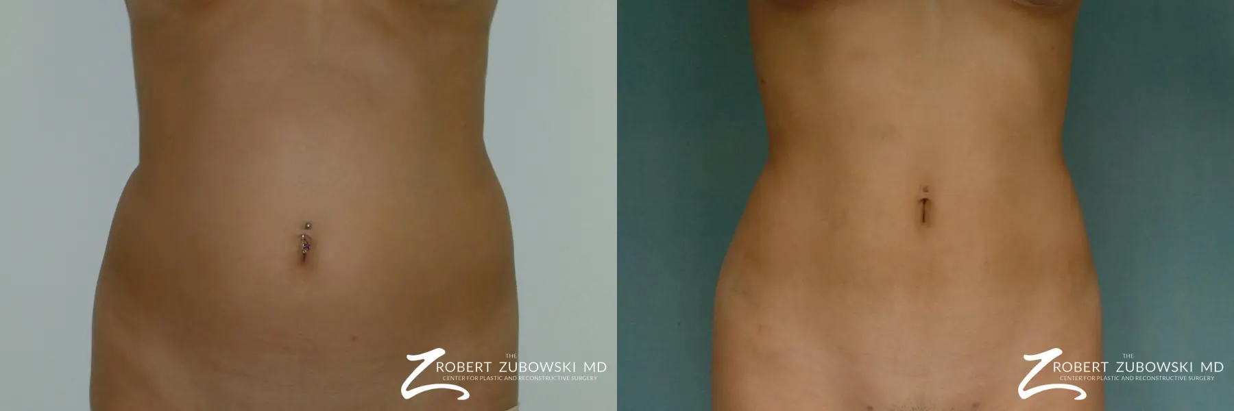 Liposuction: Patient 21 - Before and After  