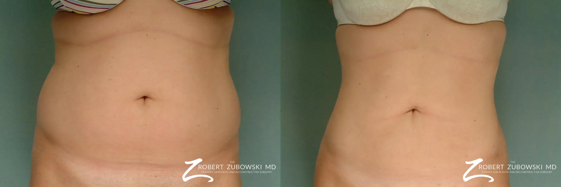 Liposuction: Patient 15 - Before and After  
