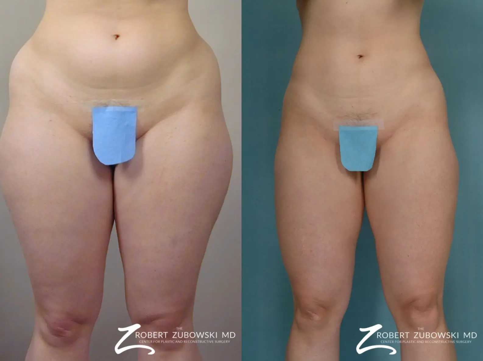 Liposuction: Patient 48 - Before and After  