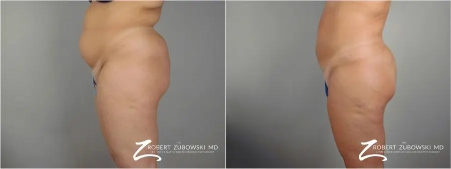 Liposuction: Patient 32 - Before and After 2