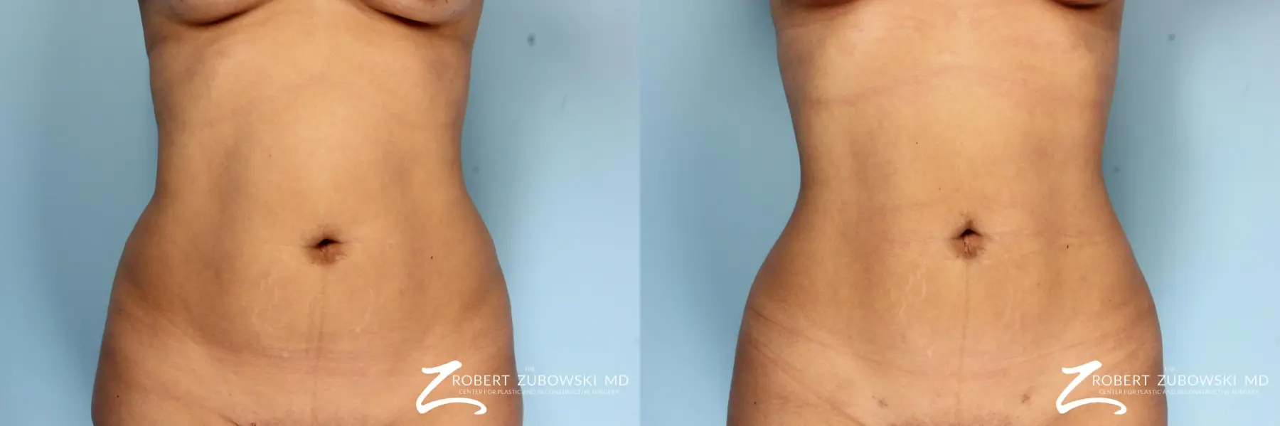 Liposuction: Patient 2 - Before and After  