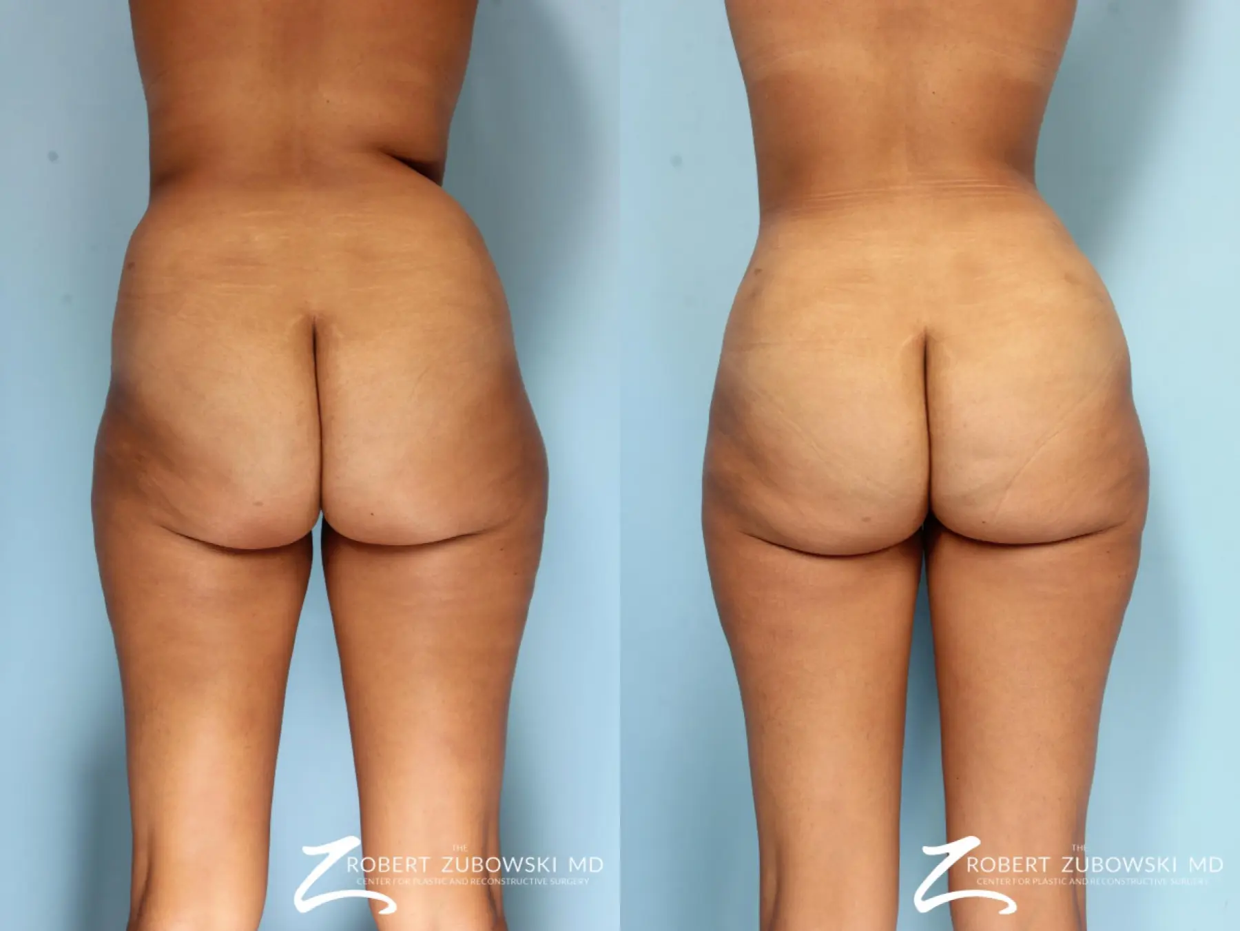 Liposuction: Patient 43 - Before and After 4