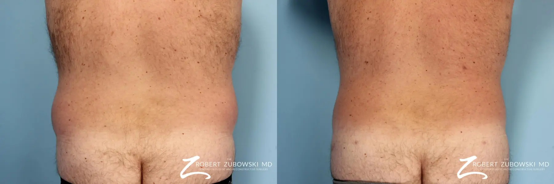 Liposuction: Patient 7 - Before and After  