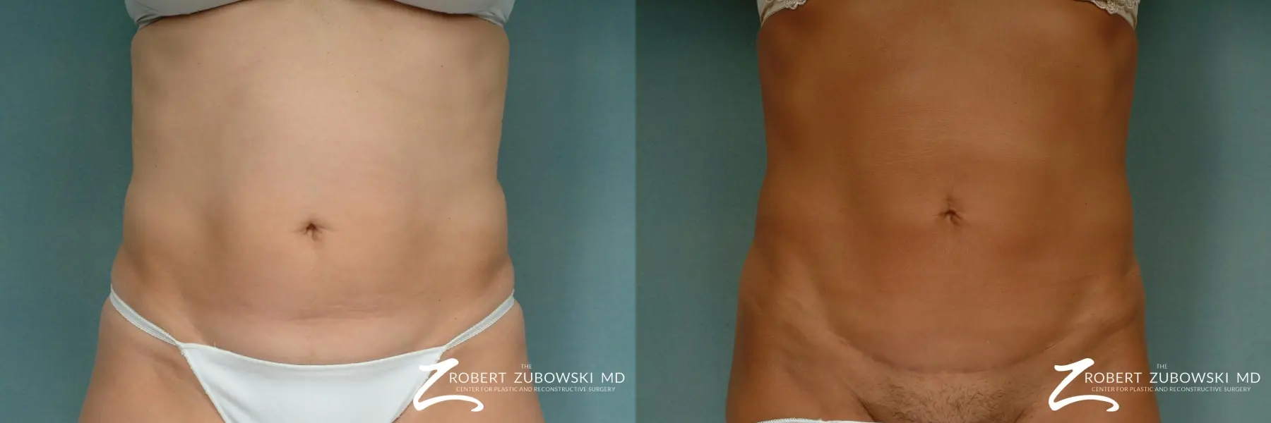 Liposuction: Patient 22 - Before and After  